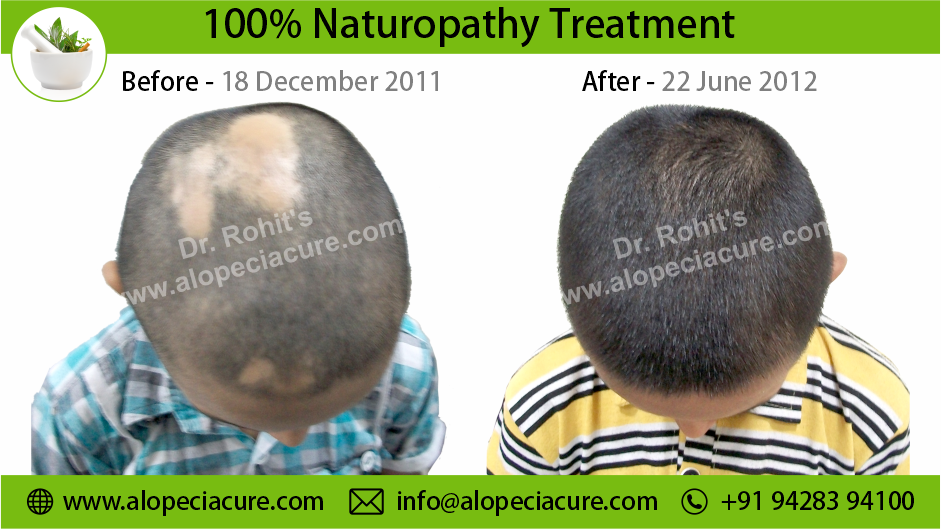 Alopecia Areata Result 6